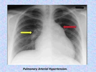 Pulmonary Arterial Hypertension.
 
