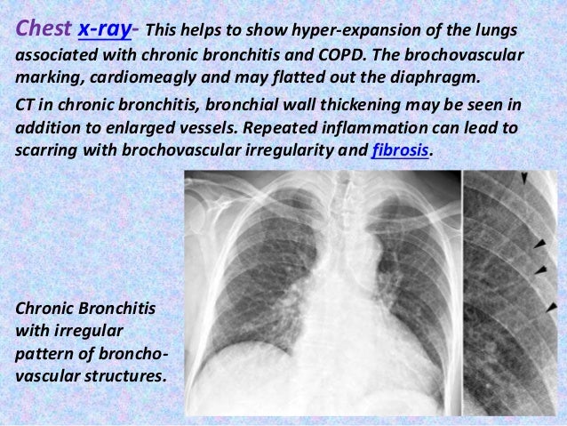 Presentation1.pptx, radiological imaging of copd.