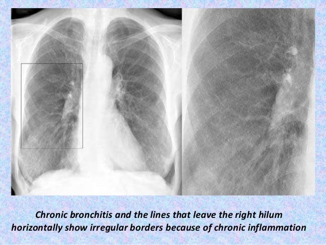 Presentation1.pptx, radiological imaging of copd.