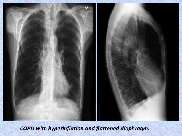 Presentation1.pptx, radiological imaging of copd.