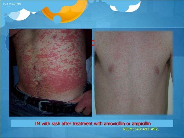 Epstein-Barr Virus | PPTX