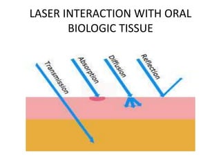 LASER INTERACTION WITH ORAL
BIOLOGIC TISSUE
 