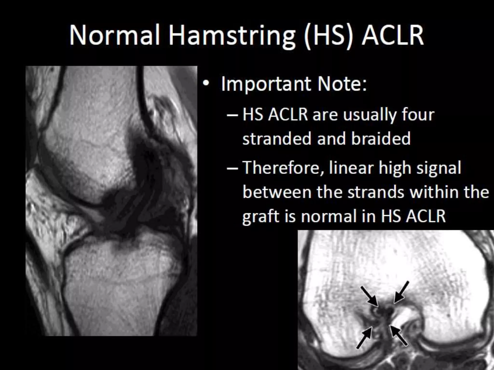 Presentation1.pptx, radiological assessment of acl graft. | PPTX