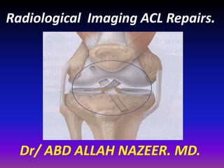 Radiological Imaging ACL Repairs.
Dr/ ABD ALLAH NAZEER. MD.
 
