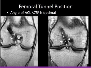 Presentation1.pptx, radiological assessment of acl graft. | PPTX