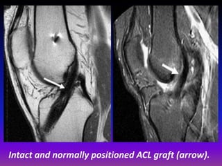 Presentation1.pptx, radiological assessment of acl graft. | PPTX