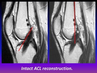 Presentation1.pptx, radiological assessment of acl graft. | PPTX