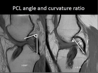 Presentation1.pptx, radiological assessment of acl graft. | PPTX