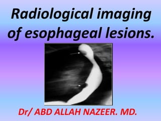 Radiological imaging
of esophageal lesions.
Dr/ ABD ALLAH NAZEER. MD.
 
