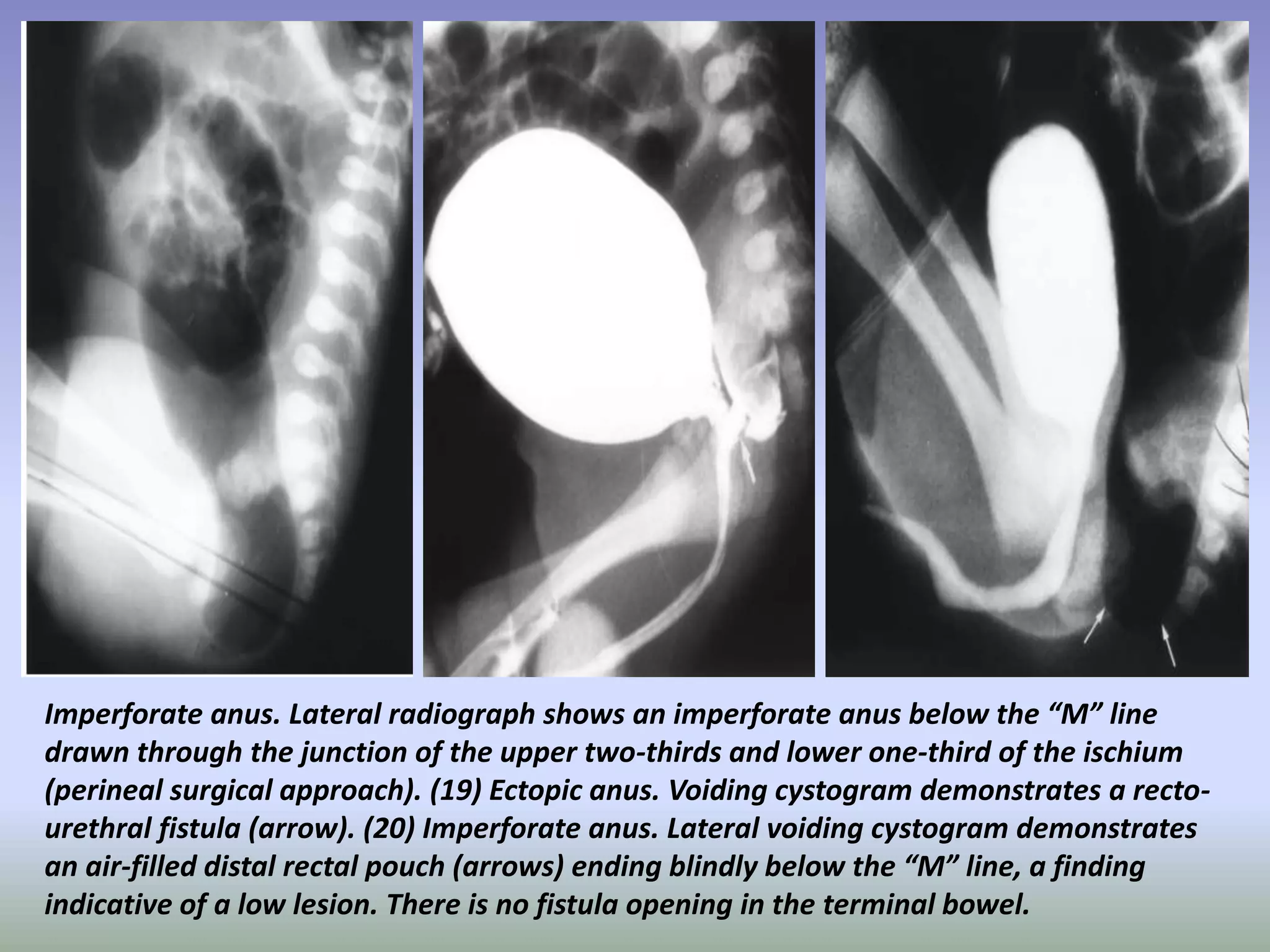 Presentation1.pptx, radiological imaging of large bowel diseases | PPTX