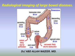 Dr/ ABD ALLAH NAZEER. MD.
Radiological imaging of large bowel diseases.
 