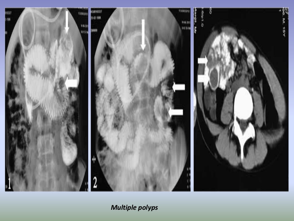 Presentation1.pptx, radiological imaging of large bowel diseases