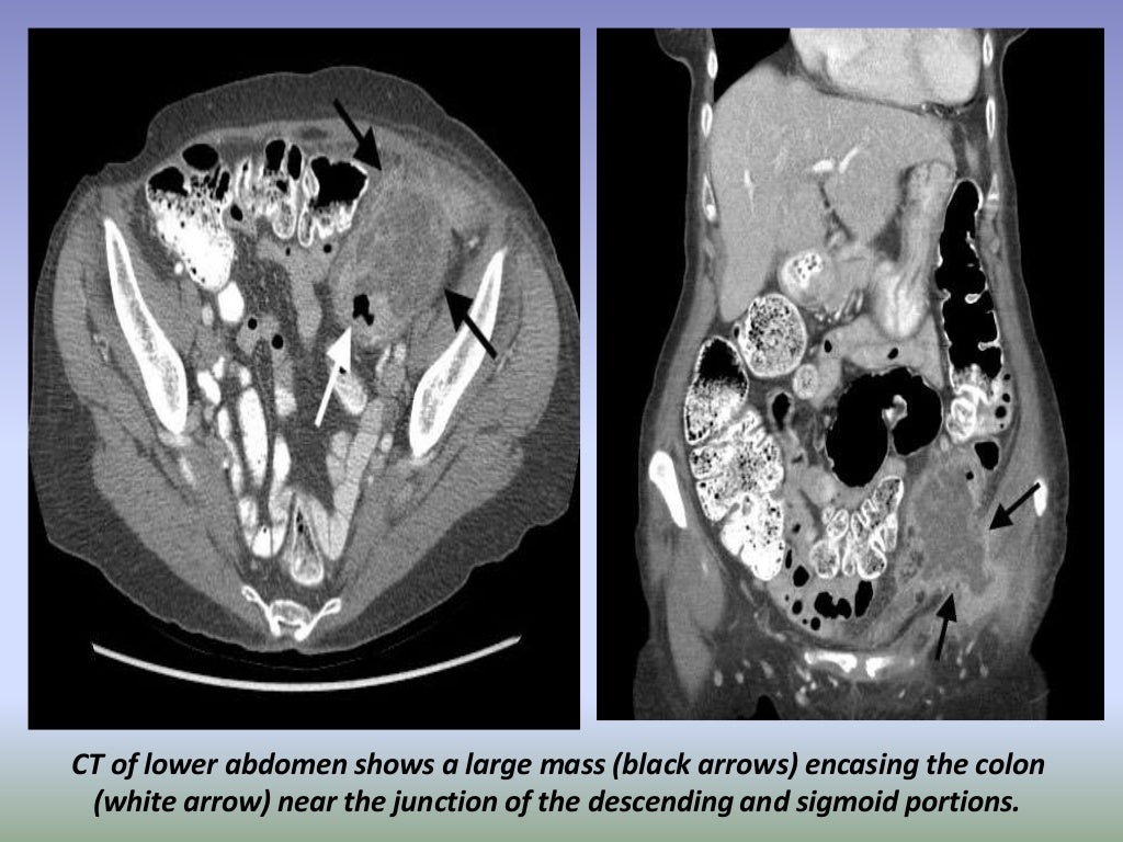 Presentation1.pptx, radiological imaging of large bowel diseases