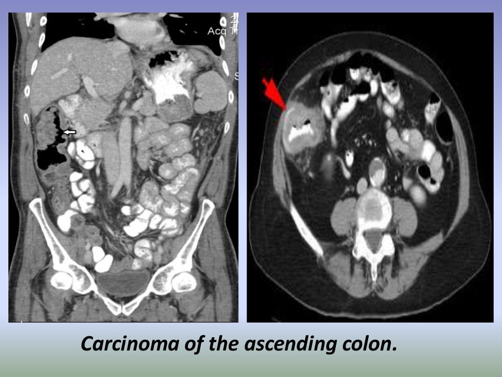 Presentation1.pptx, radiological imaging of large bowel diseases