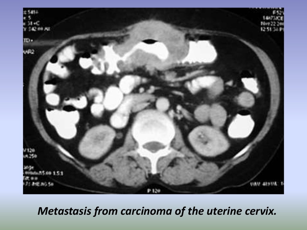 Presentation1.pptx, radiological imaging of large bowel diseases