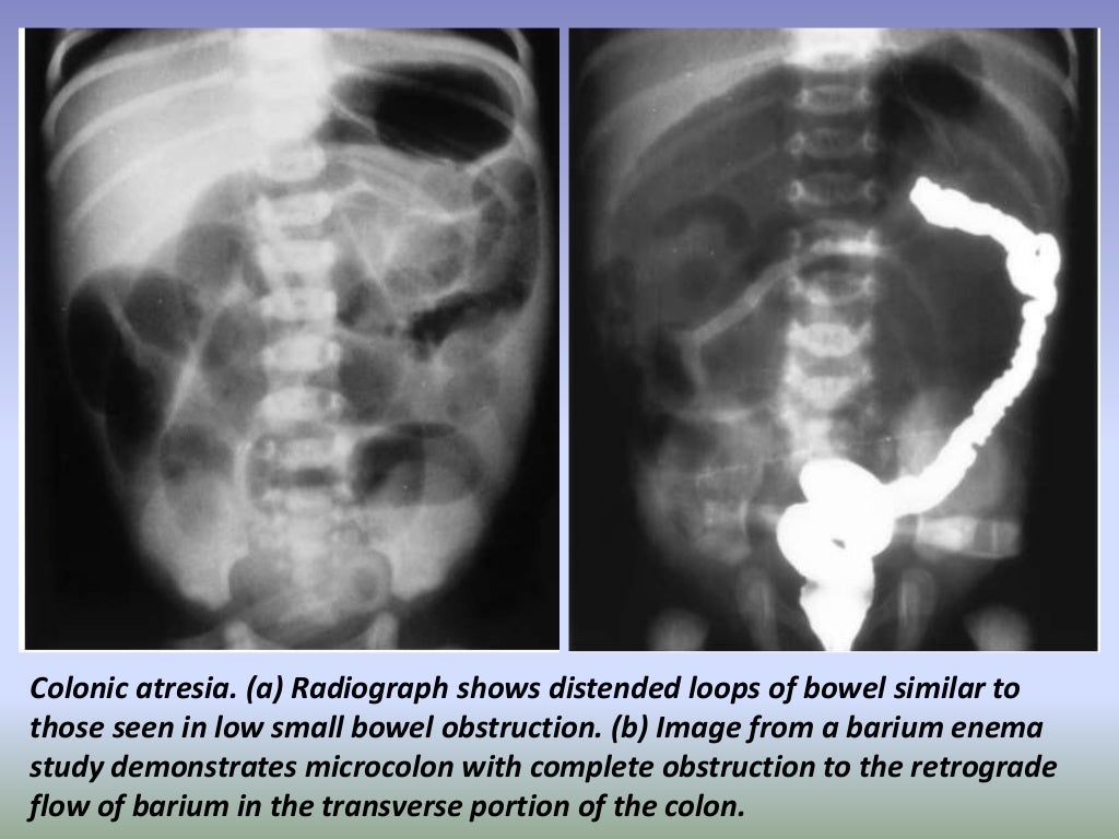 Presentation1.pptx, radiological imaging of large bowel diseases