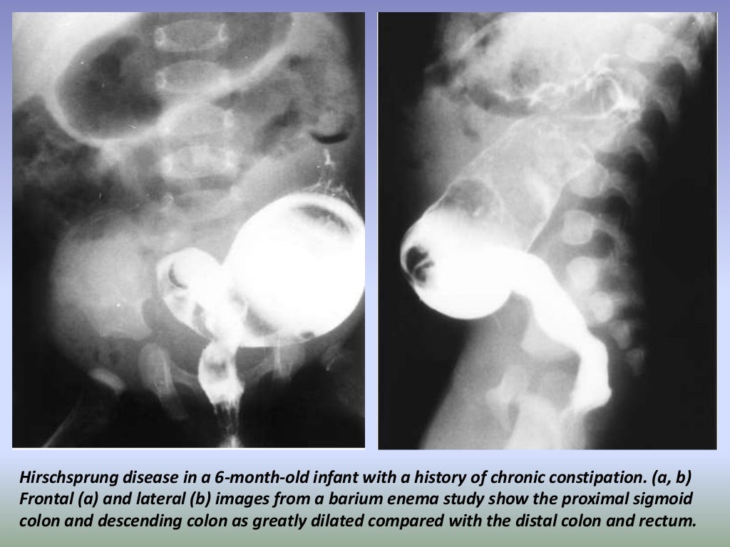 Presentation1.pptx, radiological imaging of large bowel diseases