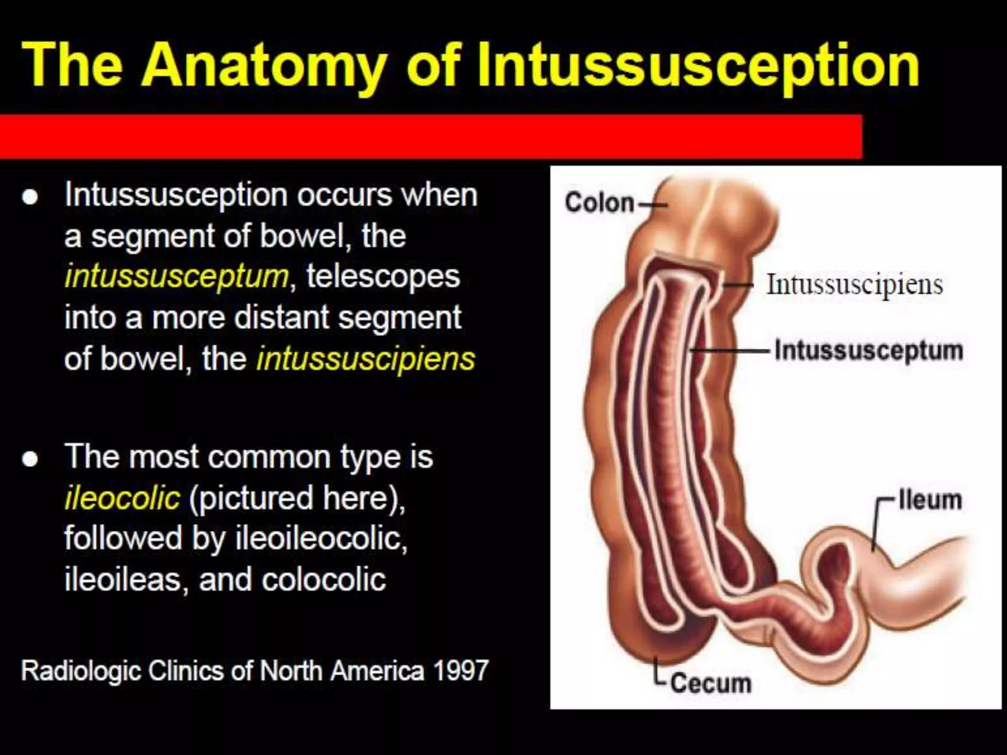 Presentation1.pptx, radiological imaging of intusussception. | PPTX