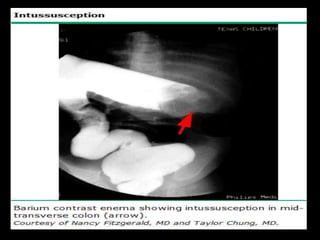 Presentation1.pptx, radiological imaging of intusussception. | PPTX
