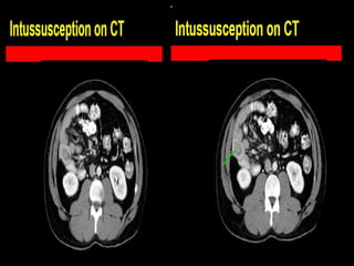 Presentation1.pptx, radiological imaging of intusussception. | PPTX