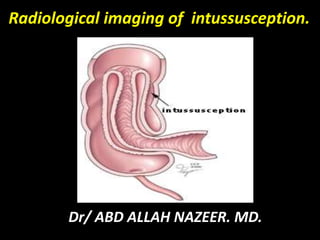 Radiological imaging of intussusception.
Dr/ ABD ALLAH NAZEER. MD.
 