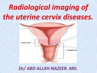 Radiological imaging of
the uterine cervix diseases.
Dr/ ABD ALLAH NAZEER. MD.
 