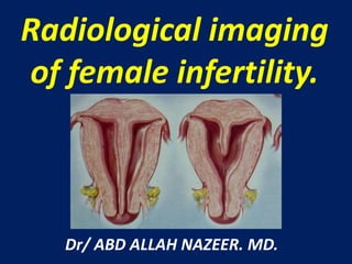 Radiological imaging
of female infertility.
Dr/ ABD ALLAH NAZEER. MD.
 