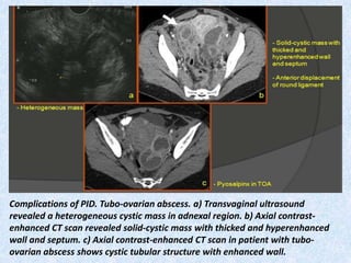 Presentation1.pptx, radiological imaging of uterine lesions. | PPTX