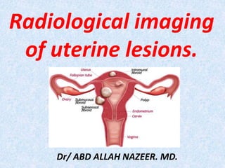 Radiological imaging
of uterine lesions.
Dr/ ABD ALLAH NAZEER. MD.
 