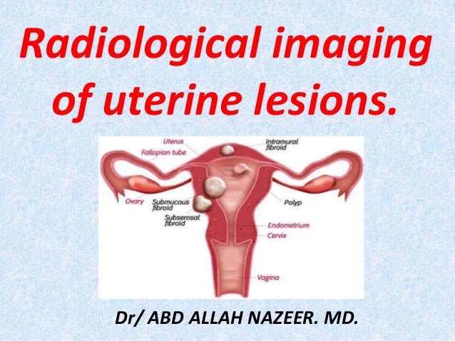 Presentation1 Pptx Radiological Imaging Of Uterine Lesions