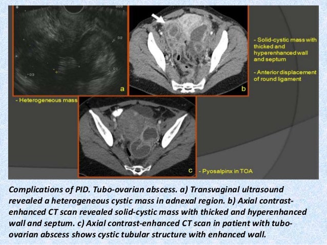 Presentation1 Pptx Radiological Imaging Of Uterine Lesions