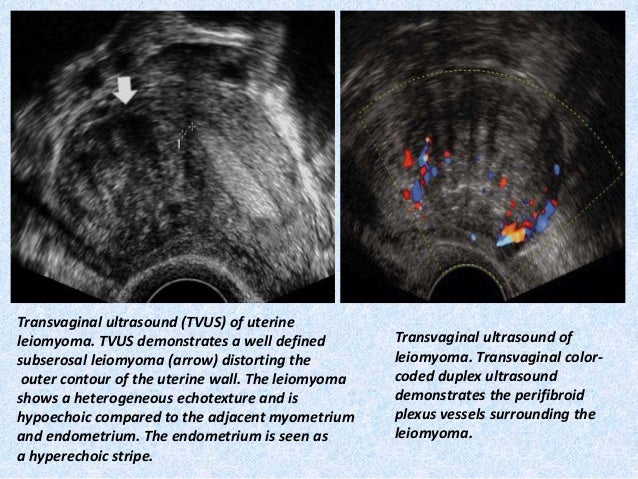 Presentation1 Pptx Radiological Imaging Of Uterine Lesions Presentation1 Pptx Radiological Imaging Of Uterine Lesions