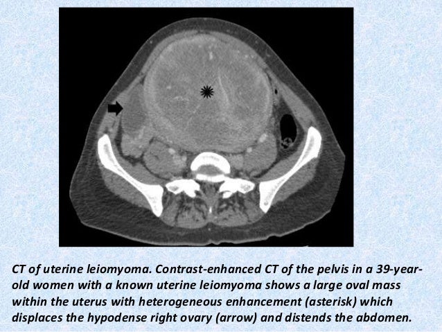 Presentation1 Pptx Radiological Imaging Of Uterine Lesions