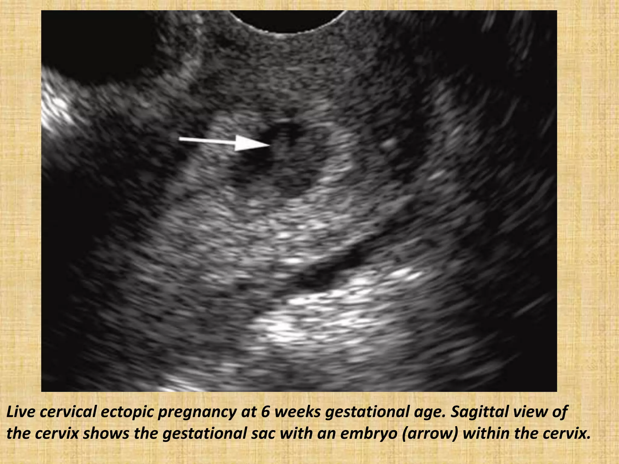 Live cervical ectopic pregnancy at 6 weeks gestational age. Sagittal view of
the cervix shows the gestational sac with an embryo (arrow) within the cervix.
 