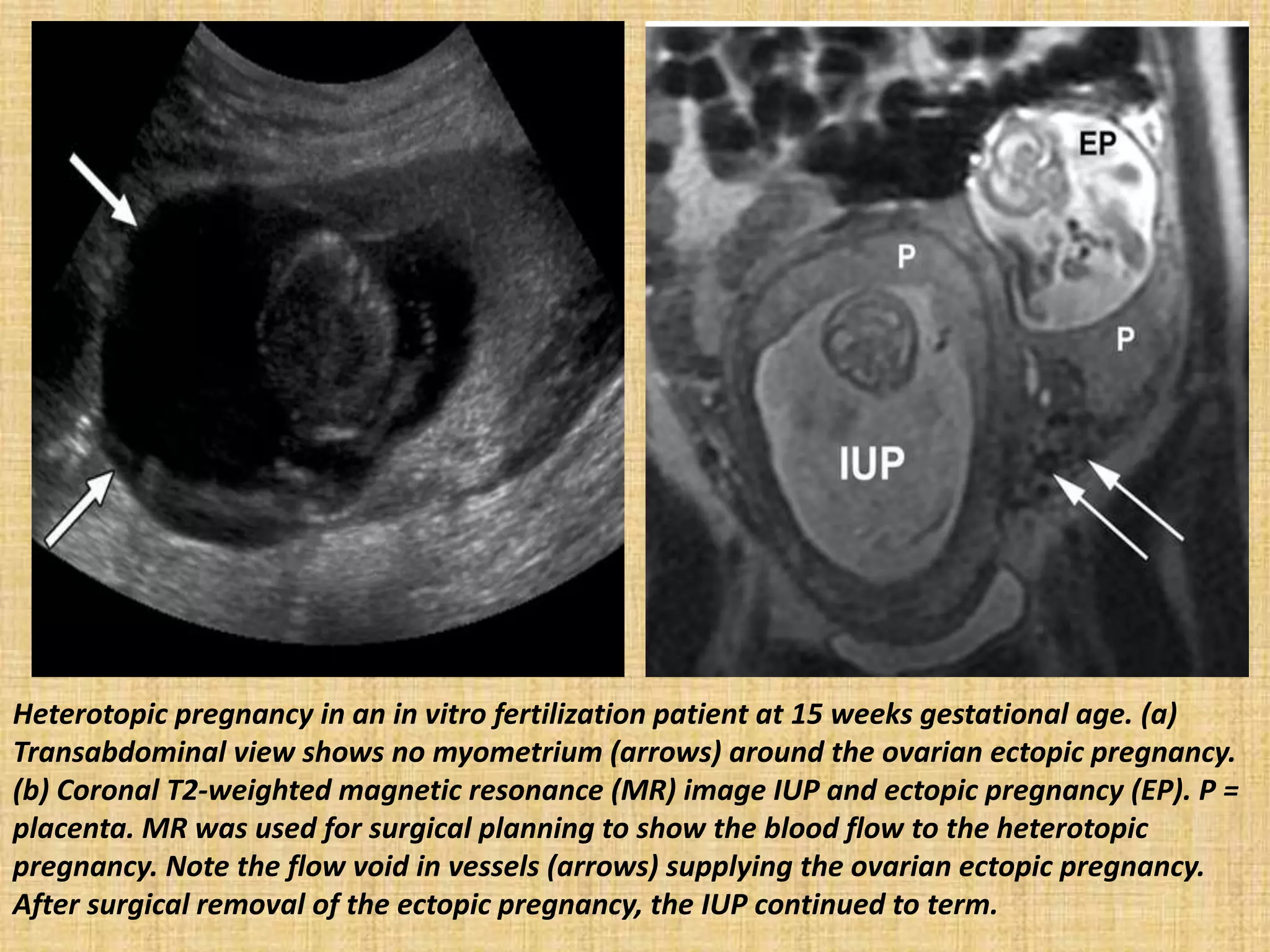 Heterotopic pregnancy in an in vitro fertilization patient at 15 weeks gestational age. (a)
Transabdominal view shows no myometrium (arrows) around the ovarian ectopic pregnancy.
(b) Coronal T2-weighted magnetic resonance (MR) image IUP and ectopic pregnancy (EP). P =
placenta. MR was used for surgical planning to show the blood flow to the heterotopic
pregnancy. Note the flow void in vessels (arrows) supplying the ovarian ectopic pregnancy.
After surgical removal of the ectopic pregnancy, the IUP continued to term.
 