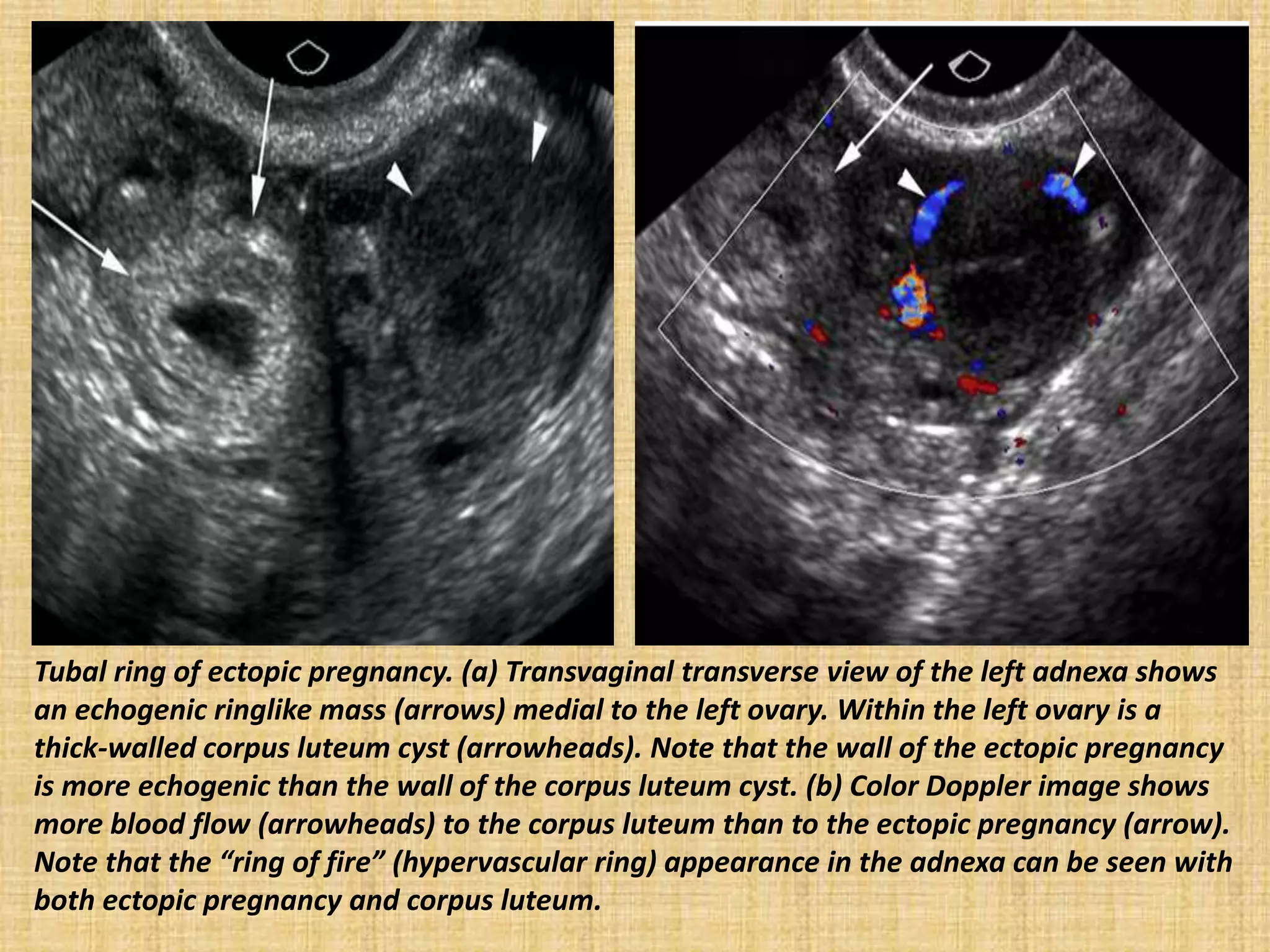 Tubal ring of ectopic pregnancy. (a) Transvaginal transverse view of the left adnexa shows
an echogenic ringlike mass (arrows) medial to the left ovary. Within the left ovary is a
thick-walled corpus luteum cyst (arrowheads). Note that the wall of the ectopic pregnancy
is more echogenic than the wall of the corpus luteum cyst. (b) Color Doppler image shows
more blood flow (arrowheads) to the corpus luteum than to the ectopic pregnancy (arrow).
Note that the “ring of fire” (hypervascular ring) appearance in the adnexa can be seen with
both ectopic pregnancy and corpus luteum.
 