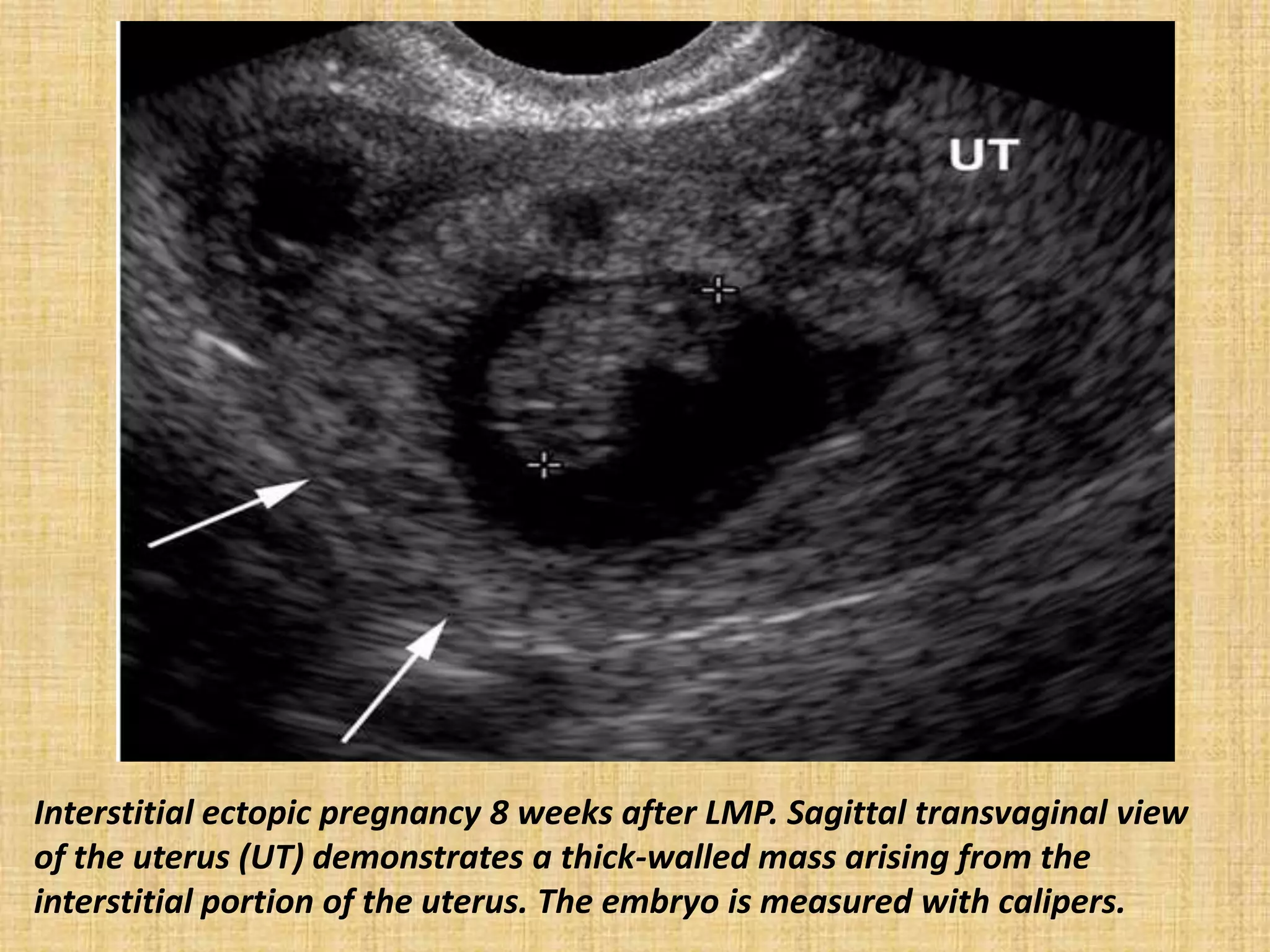 Interstitial ectopic pregnancy 8 weeks after LMP. Sagittal transvaginal view
of the uterus (UT) demonstrates a thick-walled mass arising from the
interstitial portion of the uterus. The embryo is measured with calipers.
 