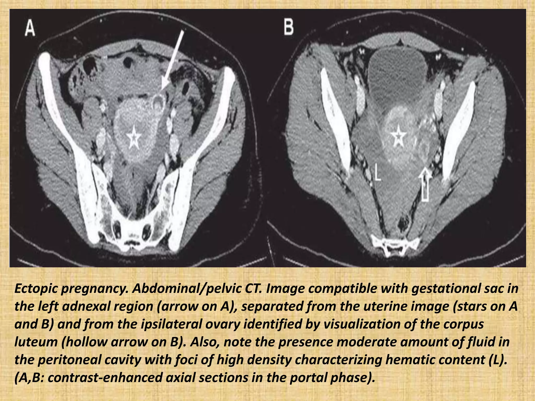 Ectopic pregnancy. Abdominal/pelvic CT. Image compatible with gestational sac in
the left adnexal region (arrow on A), separated from the uterine image (stars on A
and B) and from the ipsilateral ovary identified by visualization of the corpus
luteum (hollow arrow on B). Also, note the presence moderate amount of fluid in
the peritoneal cavity with foci of high density characterizing hematic content (L).
(A,B: contrast-enhanced axial sections in the portal phase).
 
