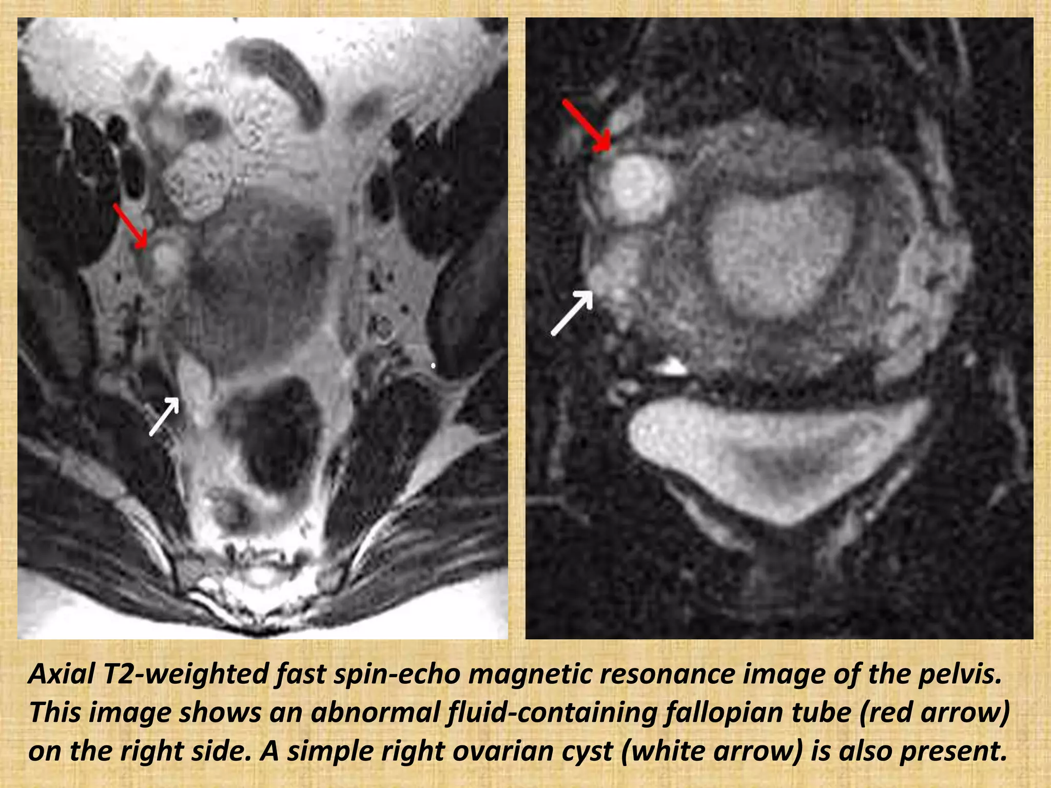 Axial T2-weighted fast spin-echo magnetic resonance image of the pelvis.
This image shows an abnormal fluid-containing fallopian tube (red arrow)
on the right side. A simple right ovarian cyst (white arrow) is also present.
 