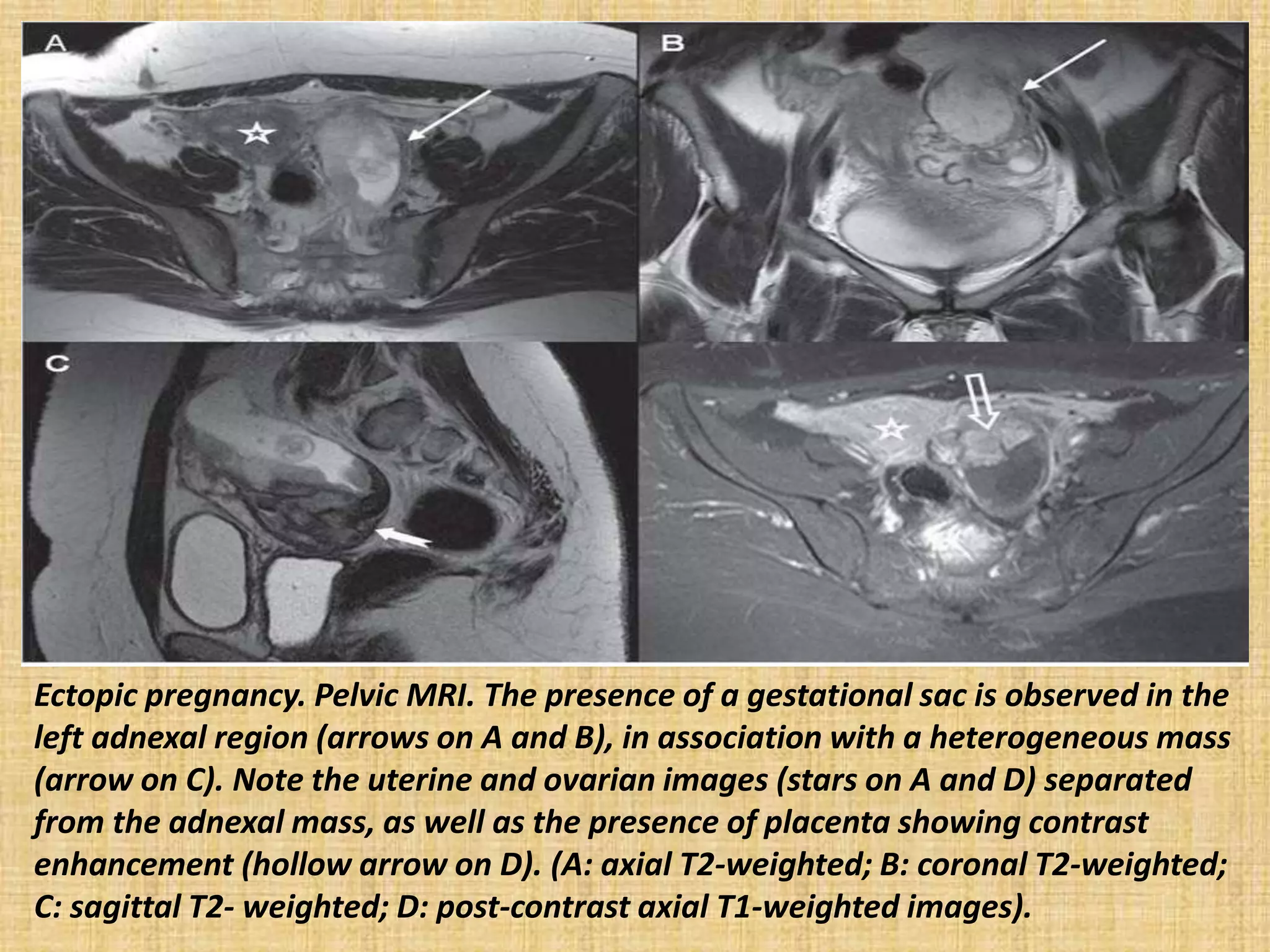 Ectopic pregnancy. Pelvic MRI. The presence of a gestational sac is observed in the
left adnexal region (arrows on A and B), in association with a heterogeneous mass
(arrow on C). Note the uterine and ovarian images (stars on A and D) separated
from the adnexal mass, as well as the presence of placenta showing contrast
enhancement (hollow arrow on D). (A: axial T2-weighted; B: coronal T2-weighted;
C: sagittal T2- weighted; D: post-contrast axial T1-weighted images).
 