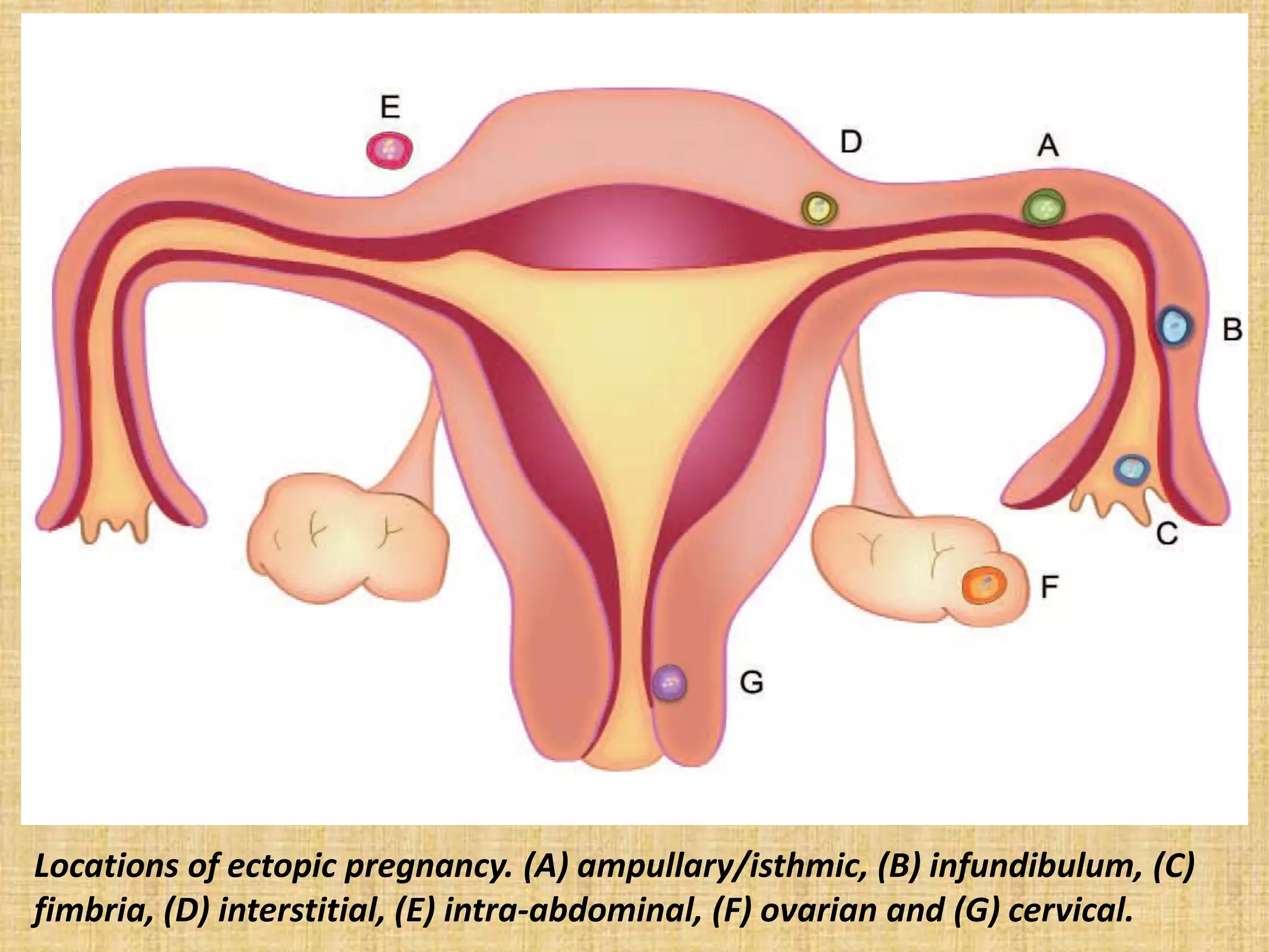 Locations of ectopic pregnancy. (A) ampullary/isthmic, (B) infundibulum, (C)
fimbria, (D) interstitial, (E) intra-abdominal, (F) ovarian and (G) cervical.
 