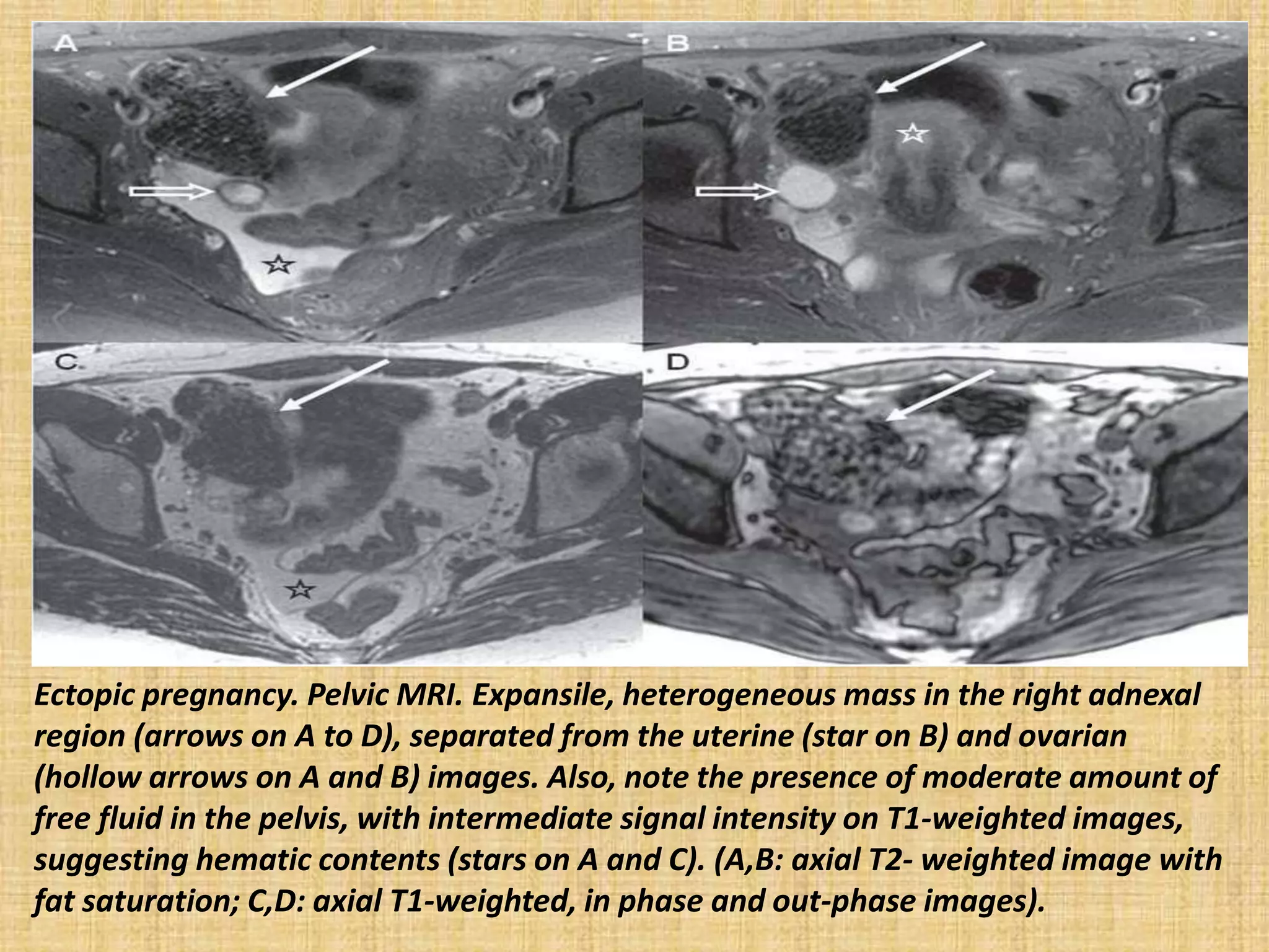 Ectopic pregnancy. Pelvic MRI. Expansile, heterogeneous mass in the right adnexal
region (arrows on A to D), separated from the uterine (star on B) and ovarian
(hollow arrows on A and B) images. Also, note the presence of moderate amount of
free fluid in the pelvis, with intermediate signal intensity on T1-weighted images,
suggesting hematic contents (stars on A and C). (A,B: axial T2- weighted image with
fat saturation; C,D: axial T1-weighted, in phase and out-phase images).
 