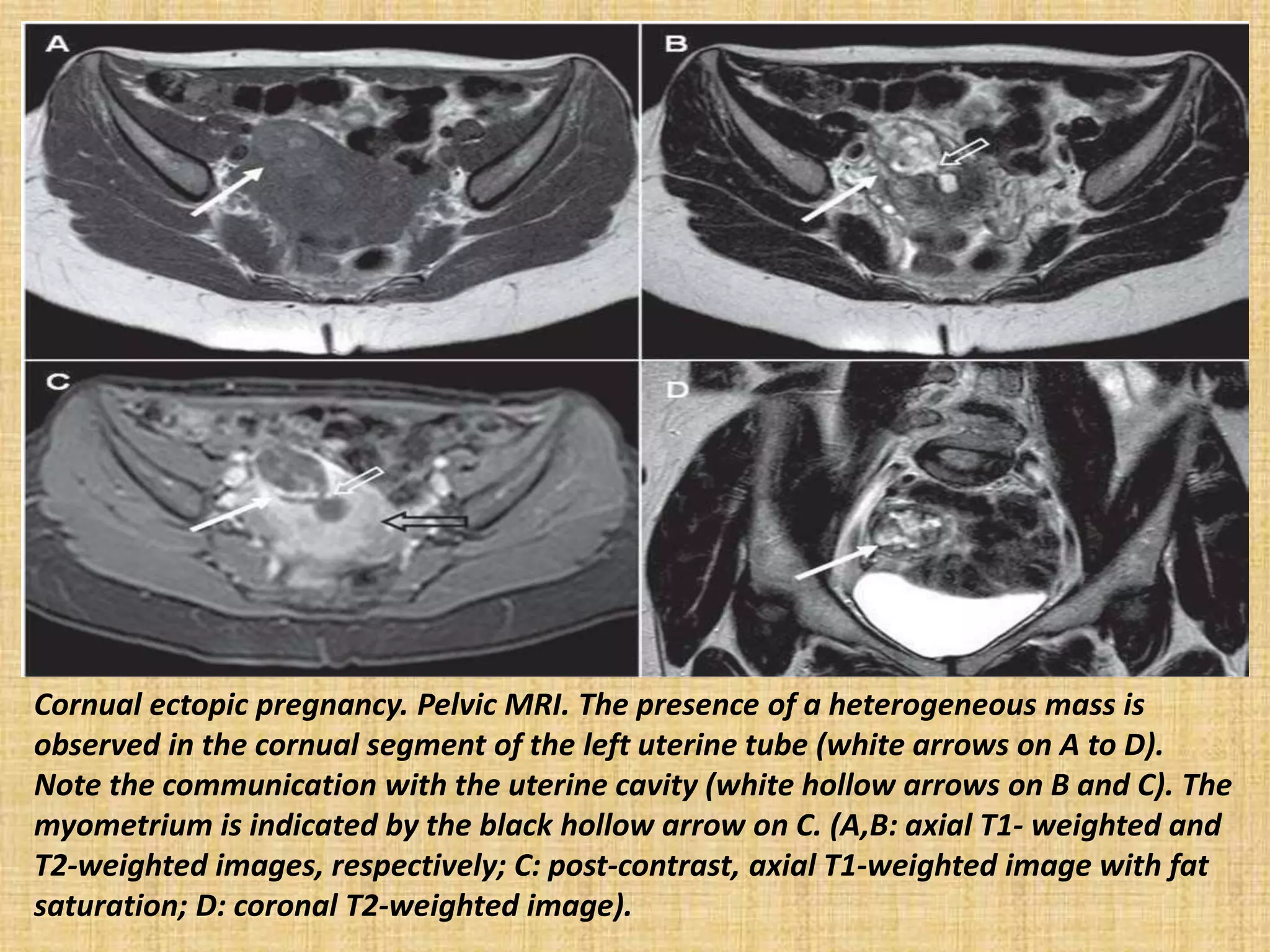 Cornual ectopic pregnancy. Pelvic MRI. The presence of a heterogeneous mass is
observed in the cornual segment of the left uterine tube (white arrows on A to D).
Note the communication with the uterine cavity (white hollow arrows on B and C). The
myometrium is indicated by the black hollow arrow on C. (A,B: axial T1- weighted and
T2-weighted images, respectively; C: post-contrast, axial T1-weighted image with fat
saturation; D: coronal T2-weighted image).
 