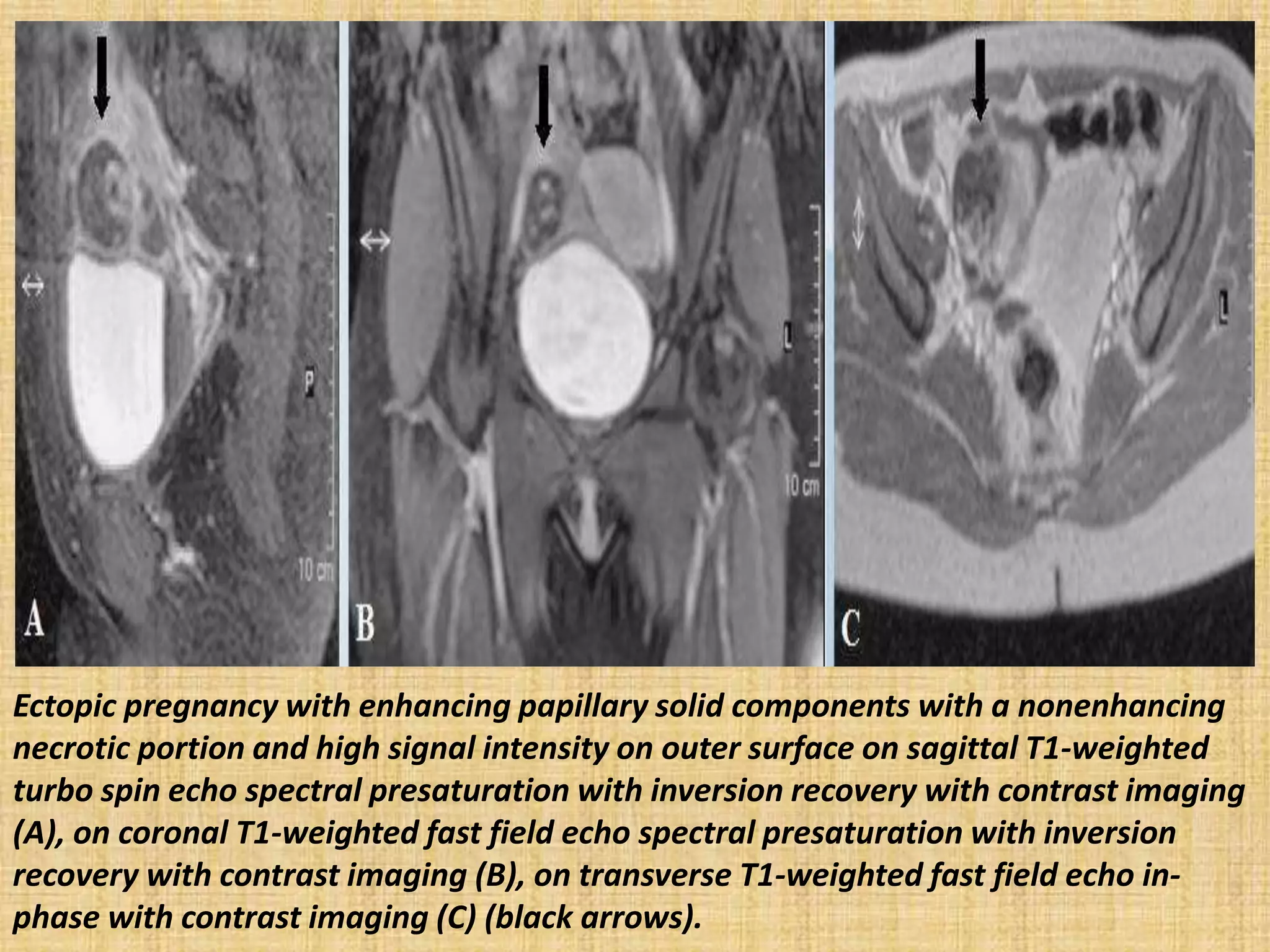 Ectopic pregnancy with enhancing papillary solid components with a nonenhancing
necrotic portion and high signal intensity on outer surface on sagittal T1-weighted
turbo spin echo spectral presaturation with inversion recovery with contrast imaging
(A), on coronal T1-weighted fast field echo spectral presaturation with inversion
recovery with contrast imaging (B), on transverse T1-weighted fast field echo in-
phase with contrast imaging (C) (black arrows).
 
