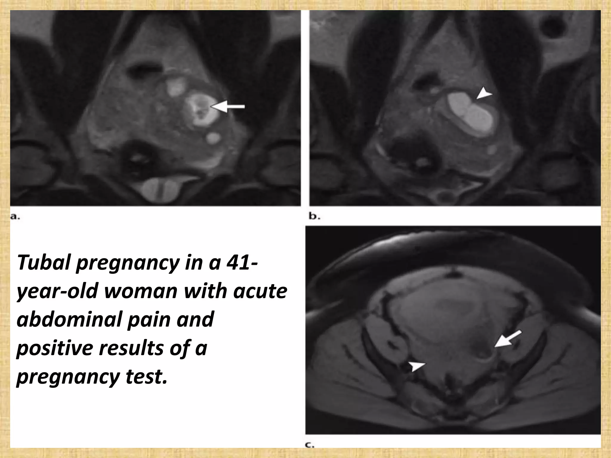Tubal pregnancy in a 41-
year-old woman with acute
abdominal pain and
positive results of a
pregnancy test.
 