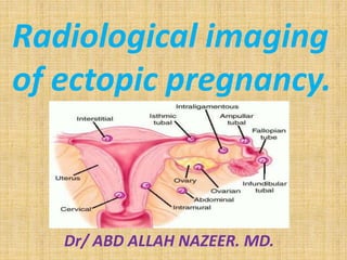 Radiological imaging
of ectopic pregnancy.
Dr/ ABD ALLAH NAZEER. MD.
 
