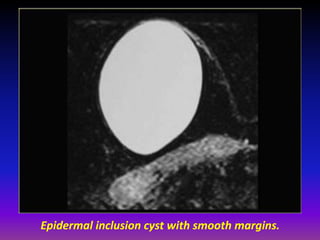 Presentation1.pptx, radiological imaging of beign breast diseases | PPTX