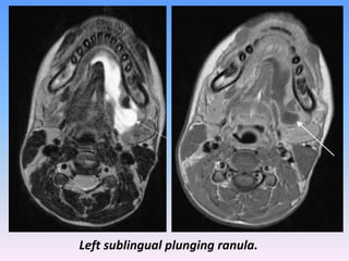 Presentation1.pptx, radiological imaging of pediatric neck masses. | PPTX