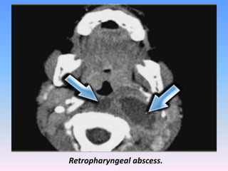Neck Abscess Radiology Presentation1.pptx, radiological imaging of pediatric neck masses. | PPTX
