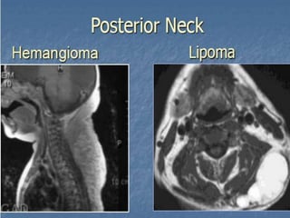 Presentation1.pptx, radiological imaging of adult neck masses.
